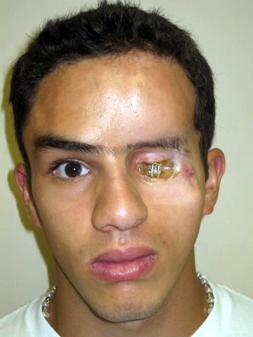 Esteban-Before