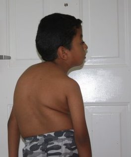 Felo scoliosis